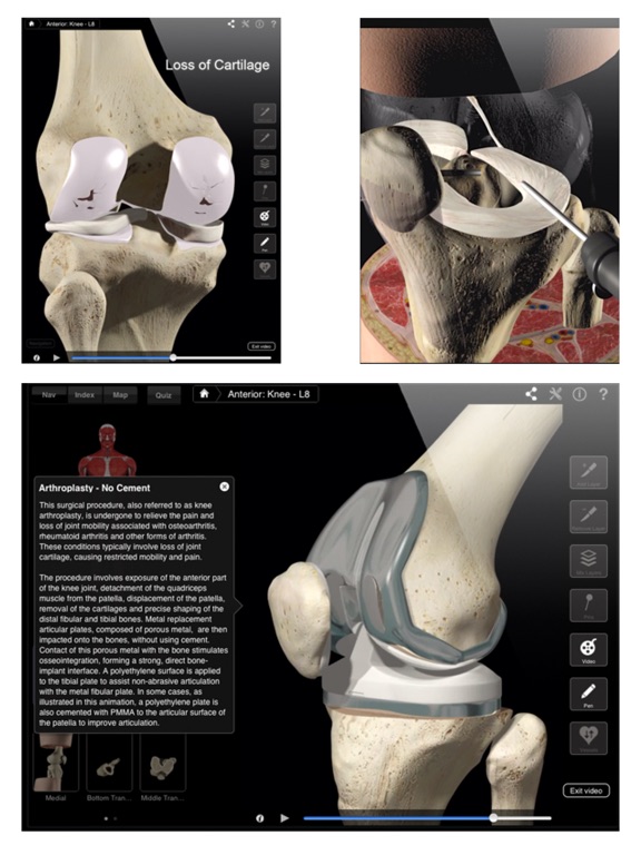 Knee Pro III - iPad Screenshots
